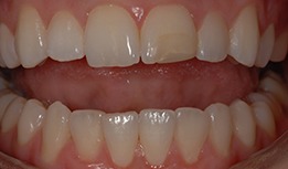Stained front tooth