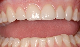 Teeth repaired with porcelain veneers