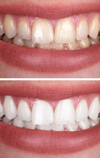 Smile before and after teeth whitening in Southlake