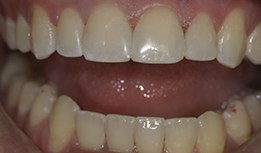 Gap between front teeth filled with composite resin