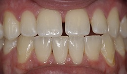 Front teeth with large gap between