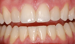 Gap filled with composite resin
