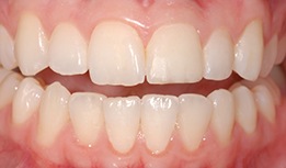 Stain on front tooth concealed with composite