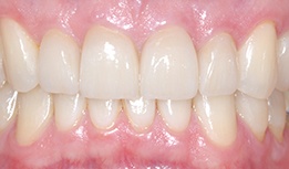 Two front teeth replacement cosmetic crowns