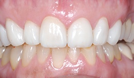 Dental crown repaired upper and lower front teeth
