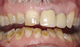 Stained and worn teeth