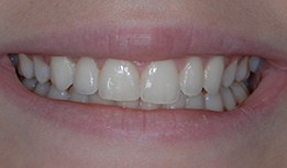 Implant retained crown tooth replacement