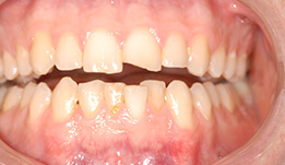 Teeth that are unevenly sized and shaped