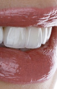A close-up of a smile with veneers in Southlake