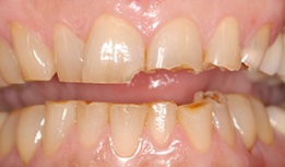 Broken upper and lower front teeth