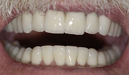 Smile with fully reconstructed teeth