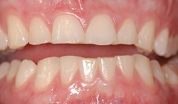 Worn and yellowed front teeth