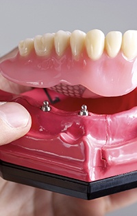Model of implant retained denture