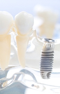 dental implants placed in a model of a mouth