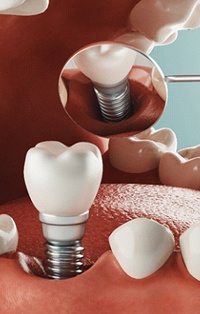 computer model of a dental implant being placed into a mouth