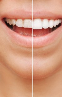 A before-and-after photo of porcelain veneers in Southlake